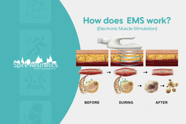 EMS treatment for post pregnancy weight loss treatment Edinburgh