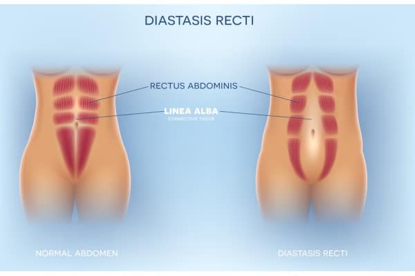 What Non-Surgical Options Are Available for Diastasis Recti Edinburgh?