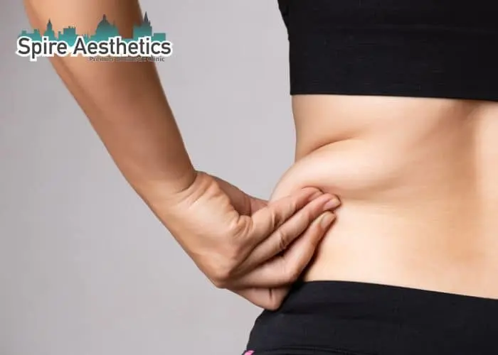 Image of woman pinching fat on their hips Edinburgh. Fat Freezing treatment