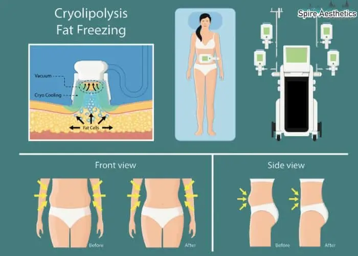 Fat freezing treatment Edinburgh benefits for competitions to remove stubborn fat deposits.