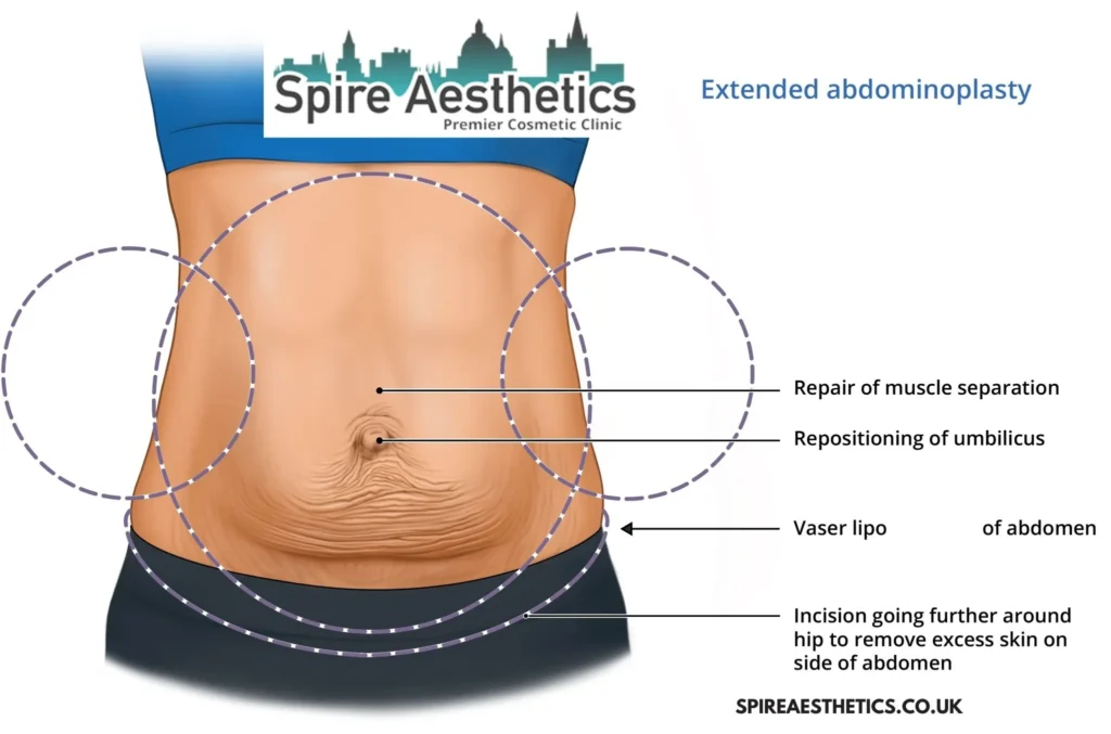 Understanding Loose Skin After Gastric Band Edinburgh Surgery and HIFU Treatment 