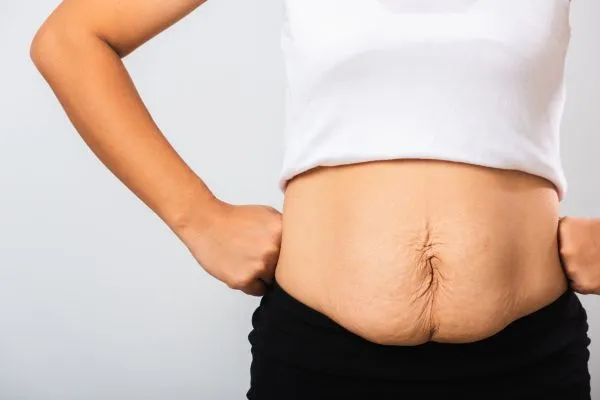 Image of a woman's stomach after weight loss with sagging skin following a gastric band Edinburgh