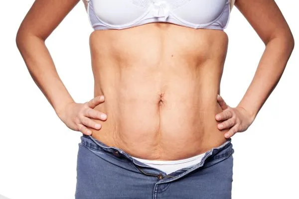 sagging skin on woman's stomach after weight loss injections Edinburgh