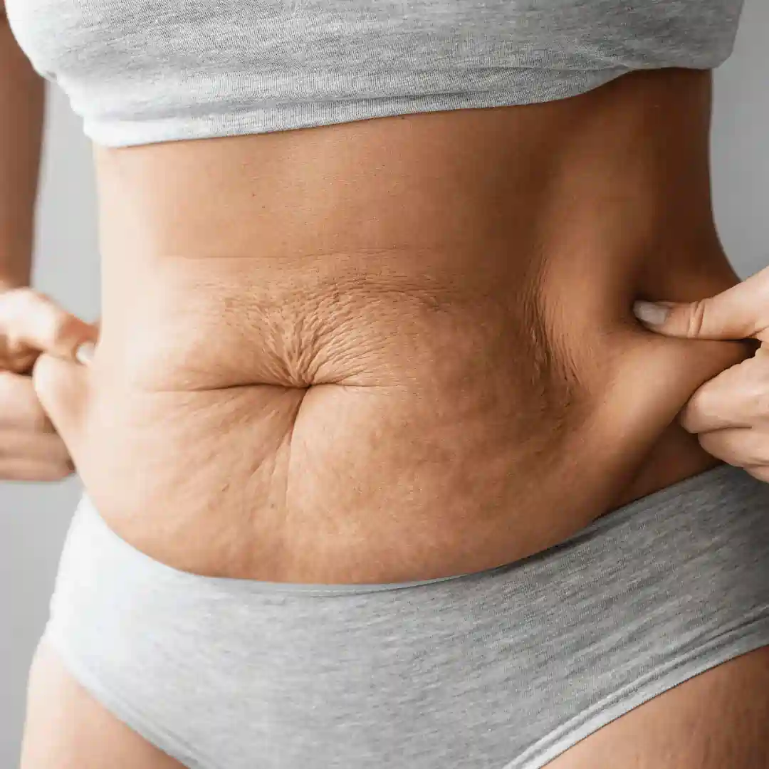 Is It Normal to Have Loose Skin After Pregnancy Edinburgh?