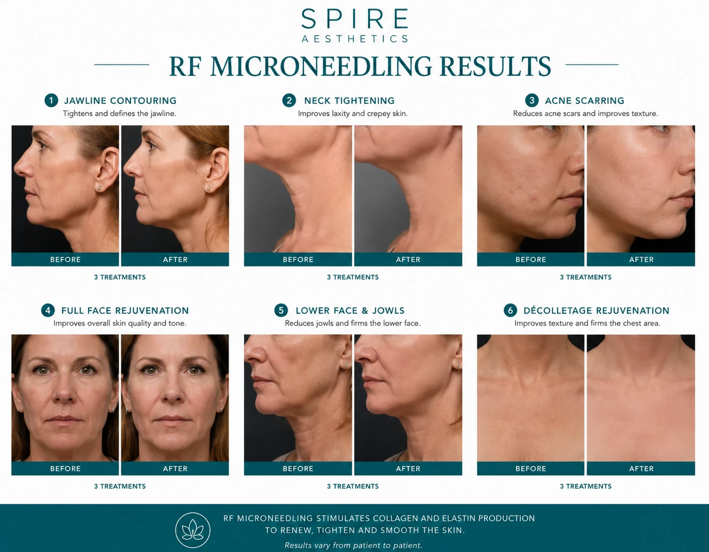 RF Microneedling Skin tightening Edinburgh results