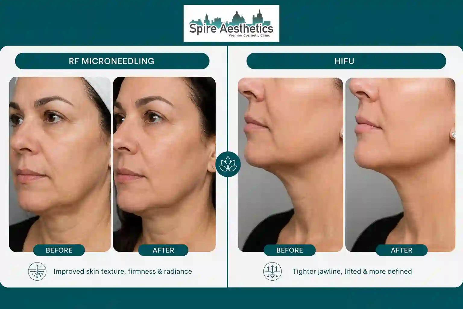 Can RF Microneedling and HIFU Be Combined Edinburgh?