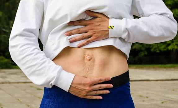 When Could Diastasis Recti Be the Missing Piece of the Puzzle Edinburgh?