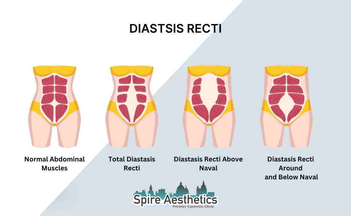 Is Non-Surgical Diastasis Recti Treatment Right for You? Common Concerns Answered Edinburgh